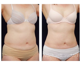 Liposuction