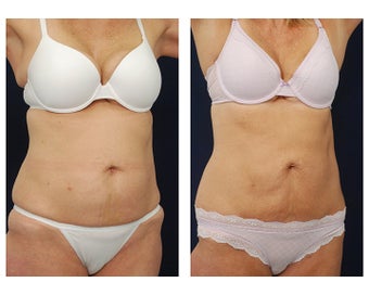 Liposuction
