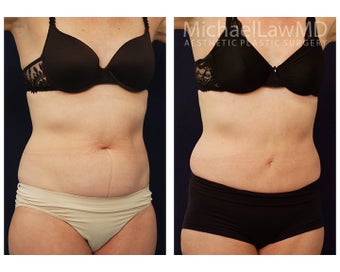 Liposuction