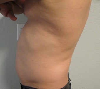 Liposuction 