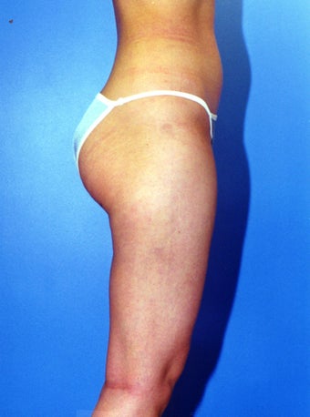 liposuction of thighs for women