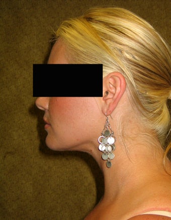 liposuction of neck & jaw line for women