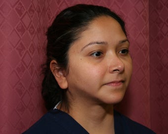 liposuction of neck & jaw line for women in Los Angeles