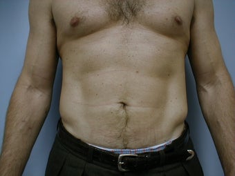 Male contouring liposuction