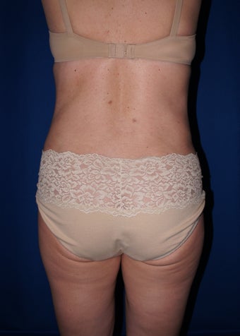 Liposuction