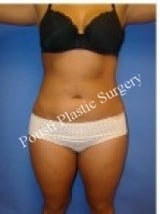Liposuction