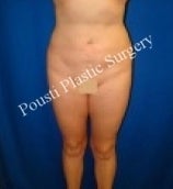 Liposuction