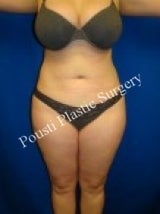 Liposuction