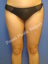 Liposuction
