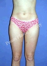 Liposuction