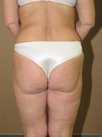 Ultrasonic liposuction thighs and fat transfer