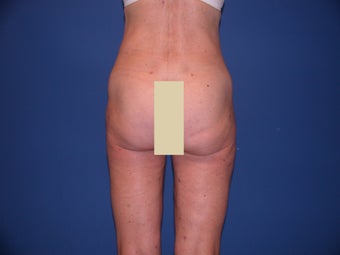 Thigh Liposculpture