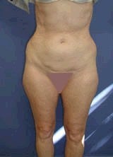 Liposculpture, Liposuction Surgery