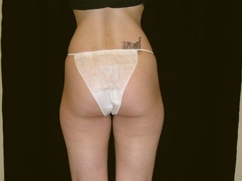 Liposuction
