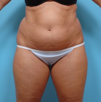 Liposuction