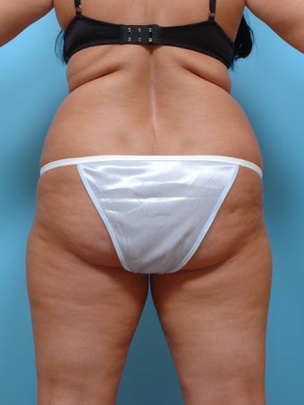 Liposuction