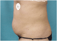 true tumescent lipo