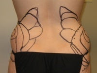 Liposuction