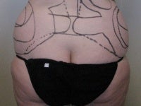 Liposuction