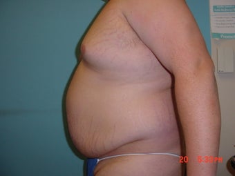 liposuction