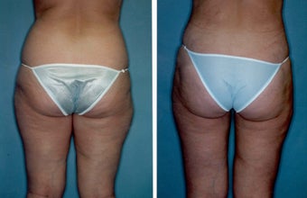 Liposuction