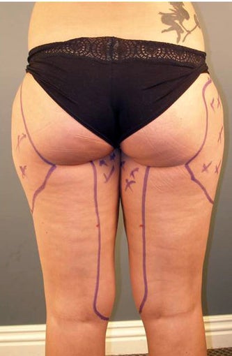 Tumescent Liposuction Under Local Anesthesia.