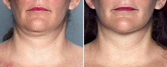 Liposuction of the Neck