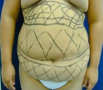 Liposculpture for stomach