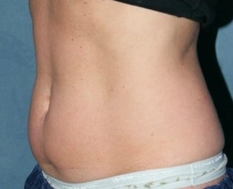 Stomach Liposculpture