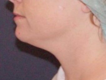Neck lipo