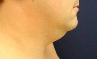 Male Neck Lipo 