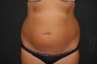 true tumescent liposuction 