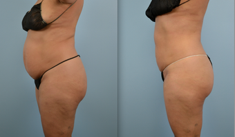 Liposuction
