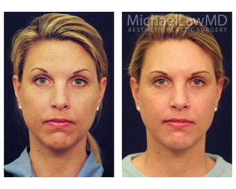 Chin Liposuction