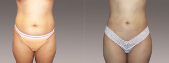 Liposuction