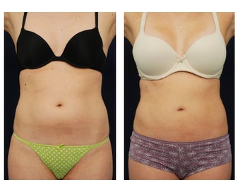 Liposuction