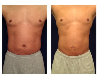 Liposuction