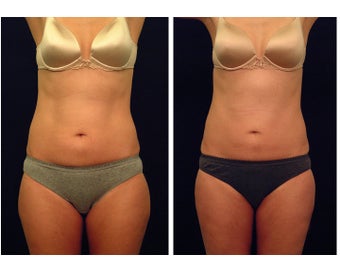 Liposuction
