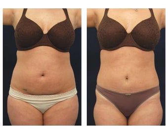 Liposuction