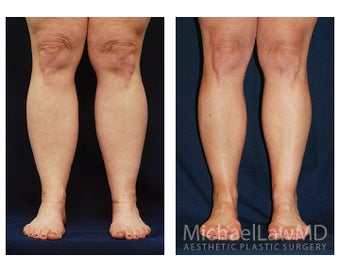 Liposuction