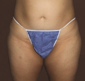 Liposuction of Abdomen, Inner Thighs and Outer Thighs