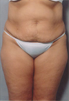 Tummy Tuck