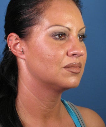 Liposuction