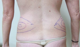 SMART Liposuction of Love Handles