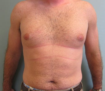 Liposuction of Abdomen, Love handles, Flanks, Chest