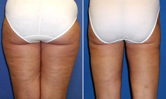Liposuction