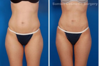 Liposuction