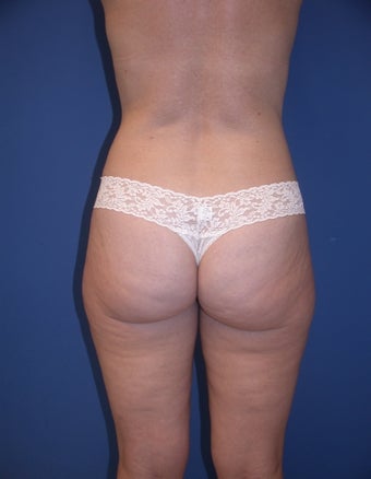 Before & After Liposculpture of the buttocks, thighs & hips