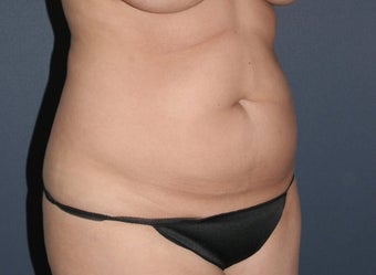 Liposculpture