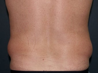 Body Liposculture